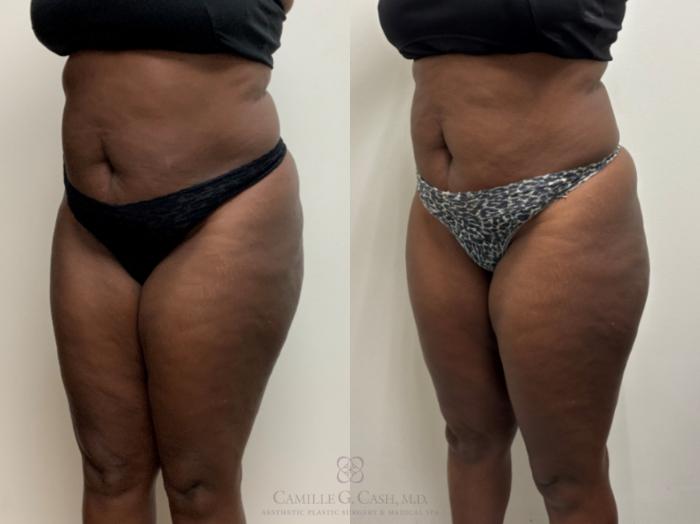 Before & After Semaglutide Weight Loss Case 691 Left Oblique View in Houston, TX