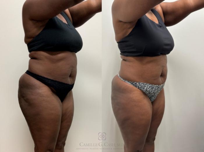 Before & After Semaglutide Weight Loss Case 691 Right Oblique View in Houston, TX