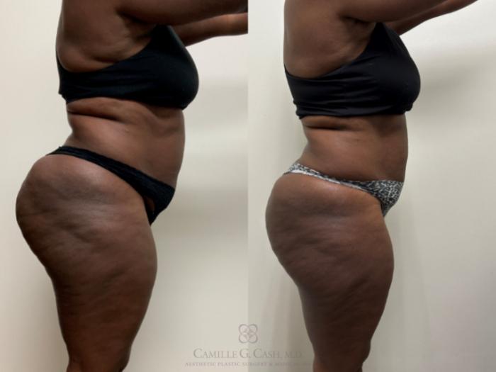 Before & After Semaglutide Weight Loss Case 691 Right Side View in Houston, TX