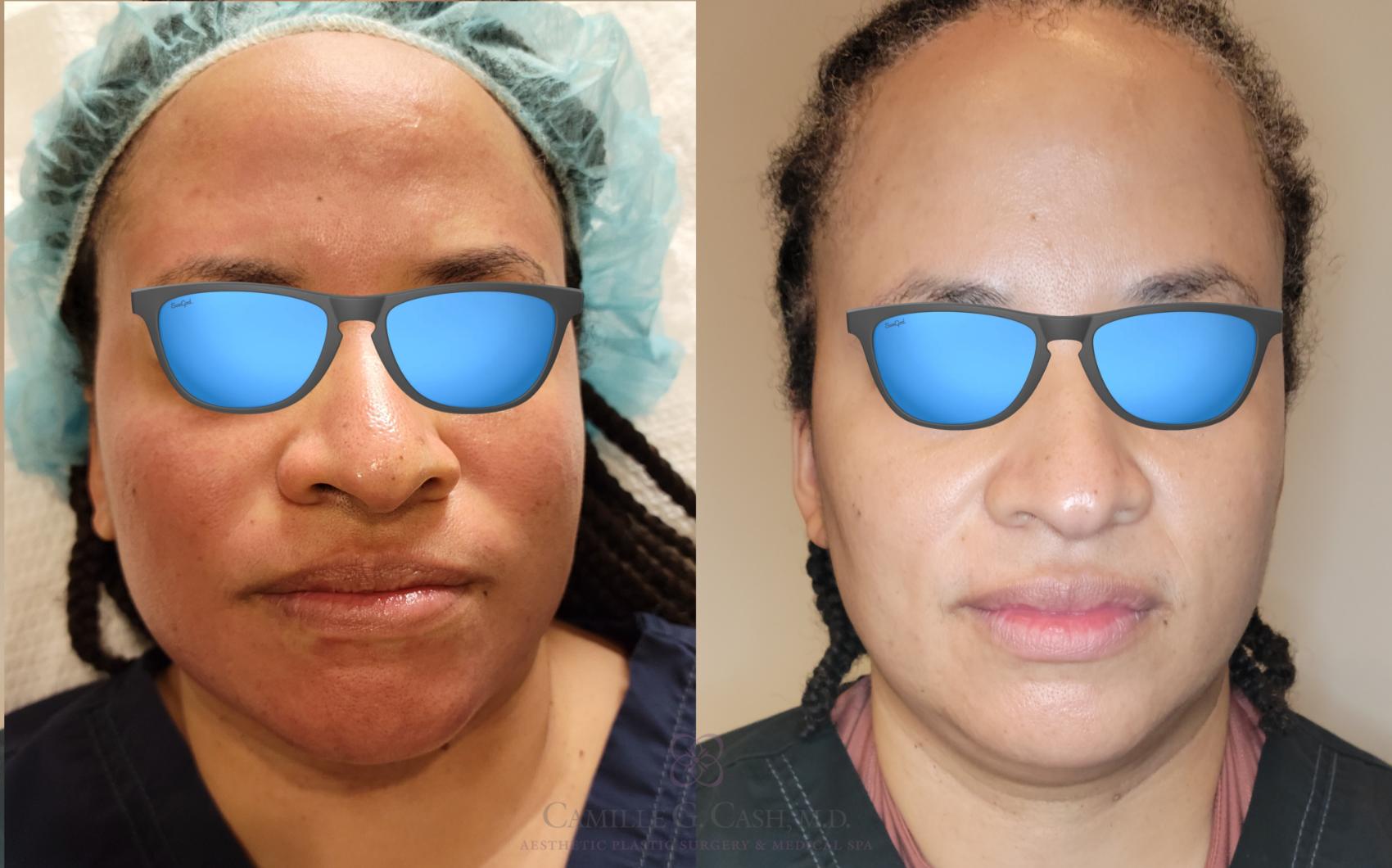 Before & After Skin Care Case 506 Front View in Houston, TX
