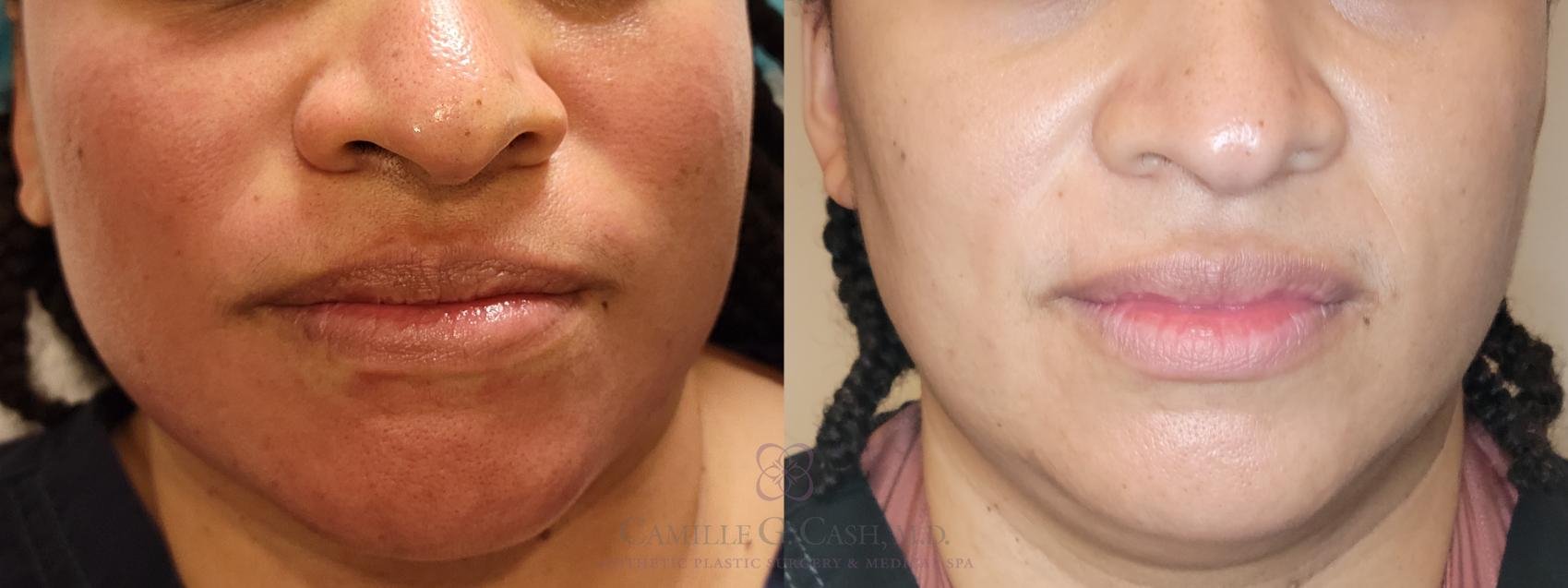Before & After Skin Care Case 506 front lower face View in Houston, TX