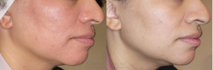 Before & After Skin Care Case 506 left ob lower View in Houston, TX