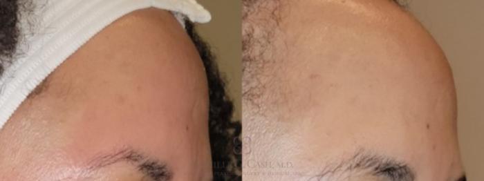 Before & After Skin Care Case 506 Left Oblique View in Houston, TX