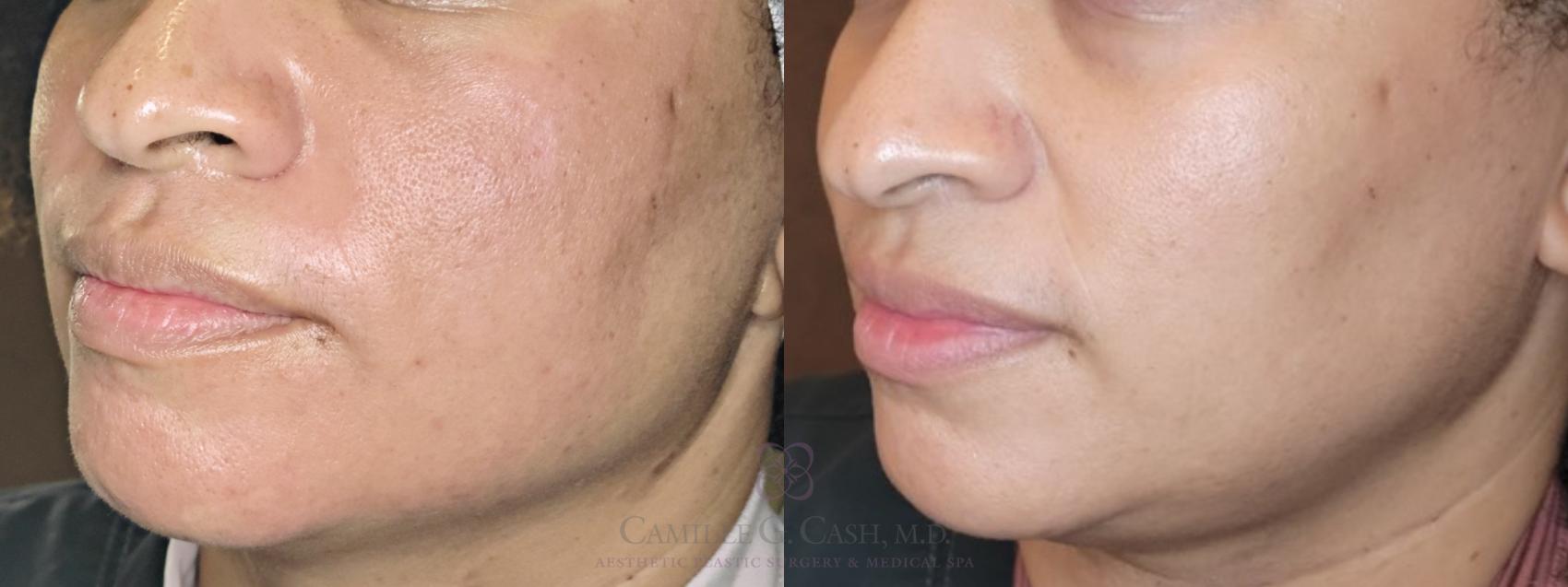 Before & After Skin Care Case 506 lower face rt View in Houston, TX