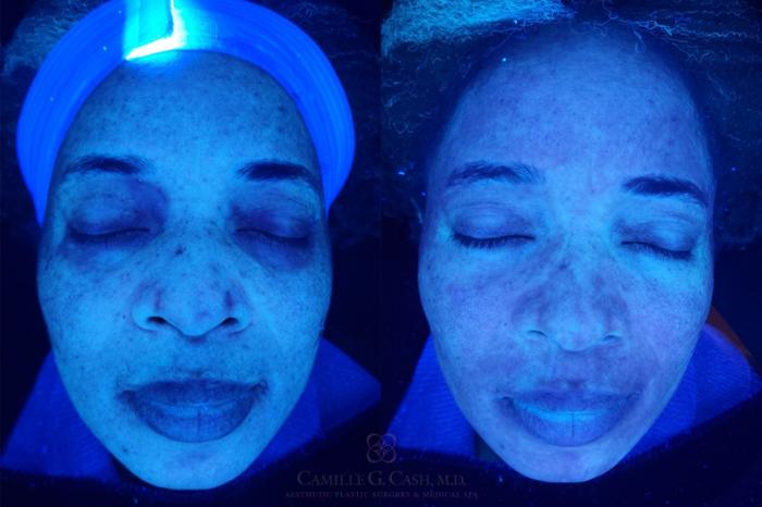 Before & After Skin Care Case 568 Front View in Houston, TX