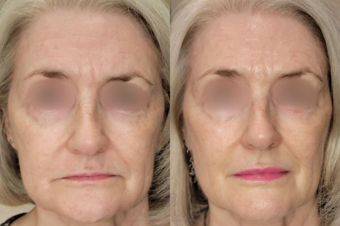Before & After Skin Care Case 648 Front View in Houston, TX