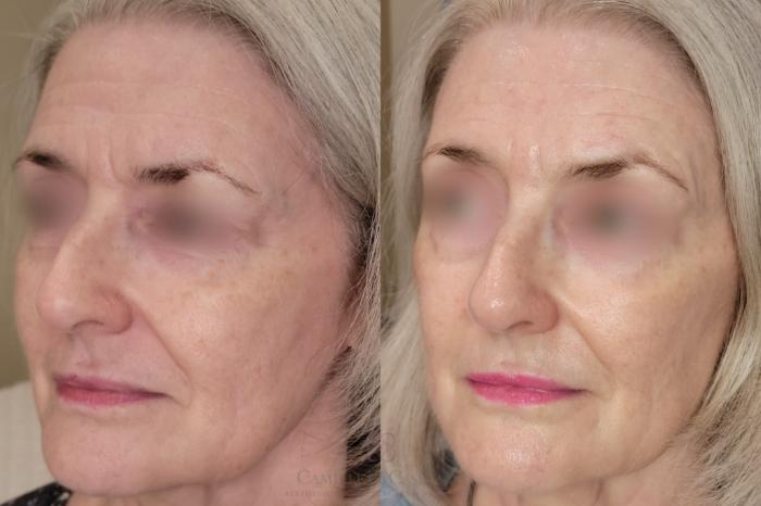 Before & After Skin Care Case 648 Left Oblique View in Houston, TX
