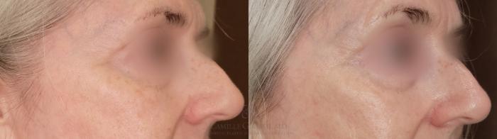 Before & After Skin Care Case 648 Right Oblique View in Houston, TX