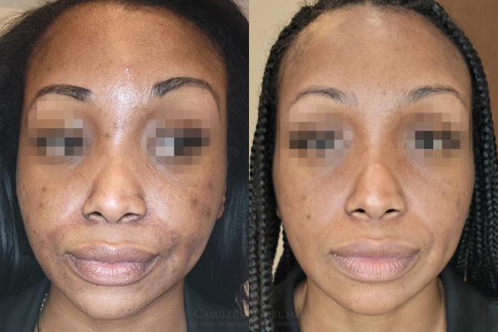 Before & After Skin Care Case 650 Front View in Houston, TX