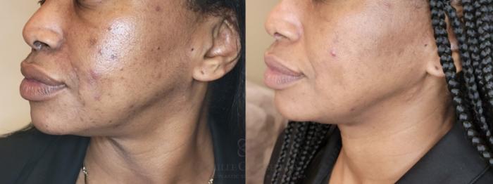 Before & After Skin Care Case 650 Left Oblique View in Houston, TX