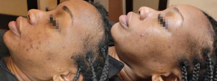 Before & After Skin Care Case 650 Left Side View in Houston, TX