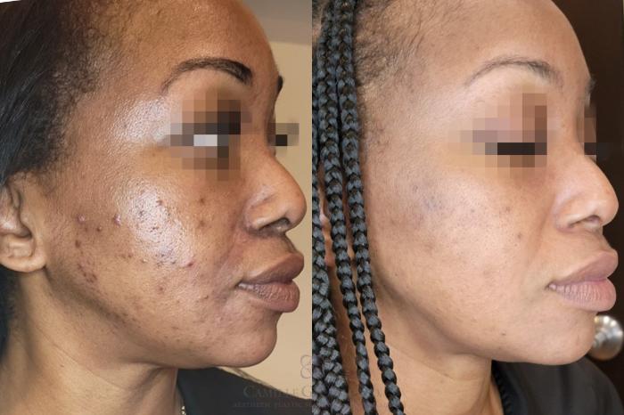 Before & After Skin Care Case 650 Right Oblique View in Houston, TX