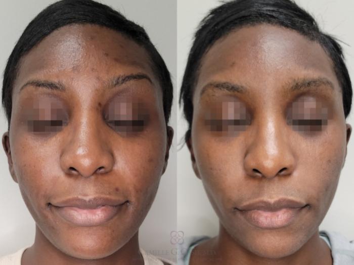 Before & After Skin Care Case 655 Front View in Houston, TX