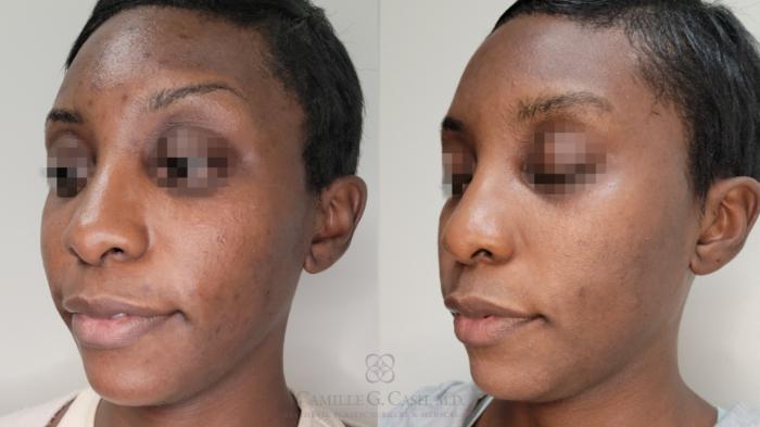 Before & After Skin Care Case 655 Left Oblique View in Houston, TX
