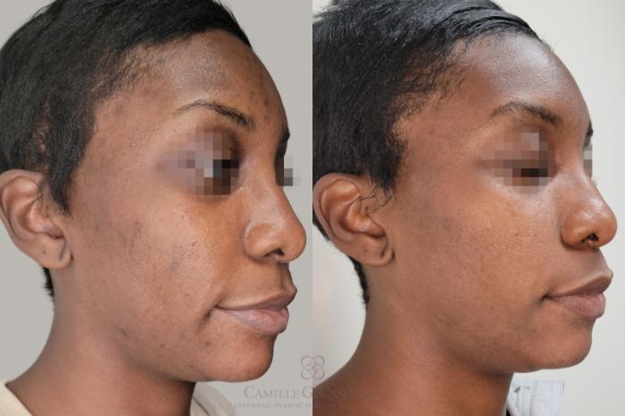 Before & After Skin Care Case 655 Right Oblique View in Houston, TX