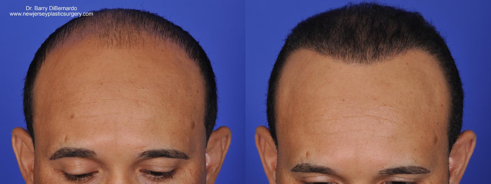 Before & After SmartGraft®  Case 420 View #2 View in Houston, TX