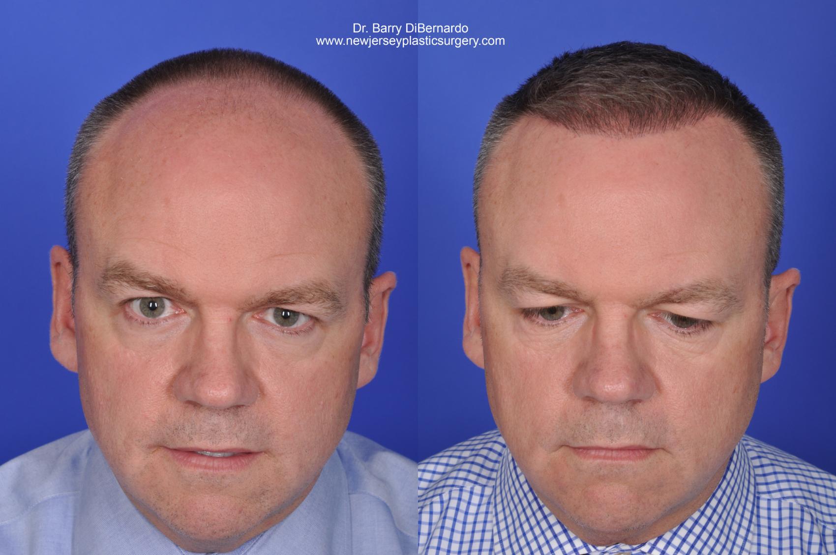 Before & After SmartGraft®  Case 421 View #1 View in Houston, TX