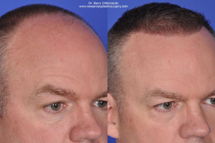 Before & After SmartGraft®  Case 421 View #2 View in Houston, TX