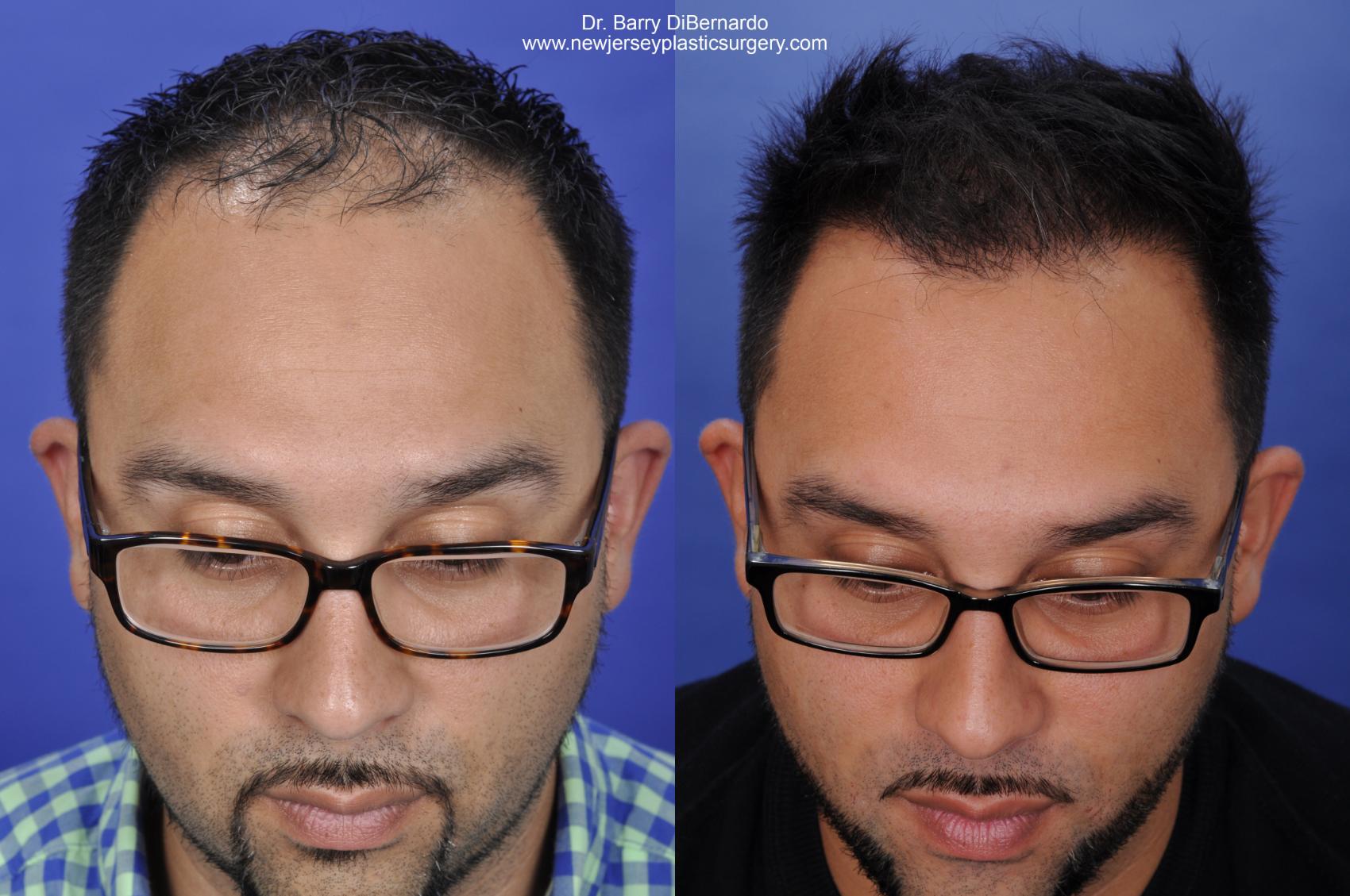 Before & After SmartGraft®  Case 423 View #1 View in Houston, TX