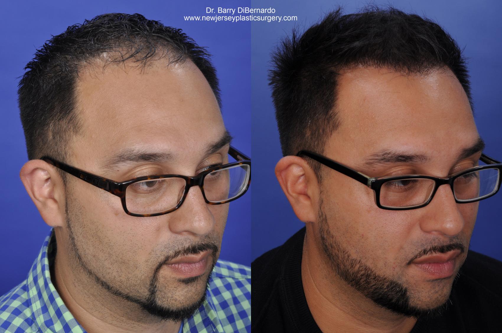 Before & After SmartGraft®  Case 423 View #2 View in Houston, TX