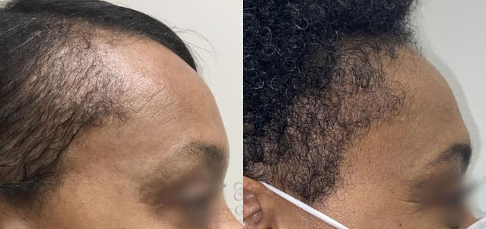 Before & After SmartGraft®  Case 424 View #3 View in Houston, TX
