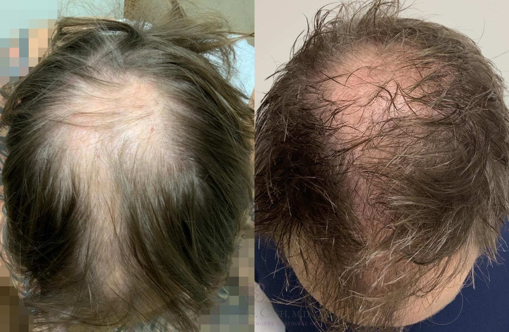 Before & After SmartGraft®  Case 488 2 View in Houston, TX