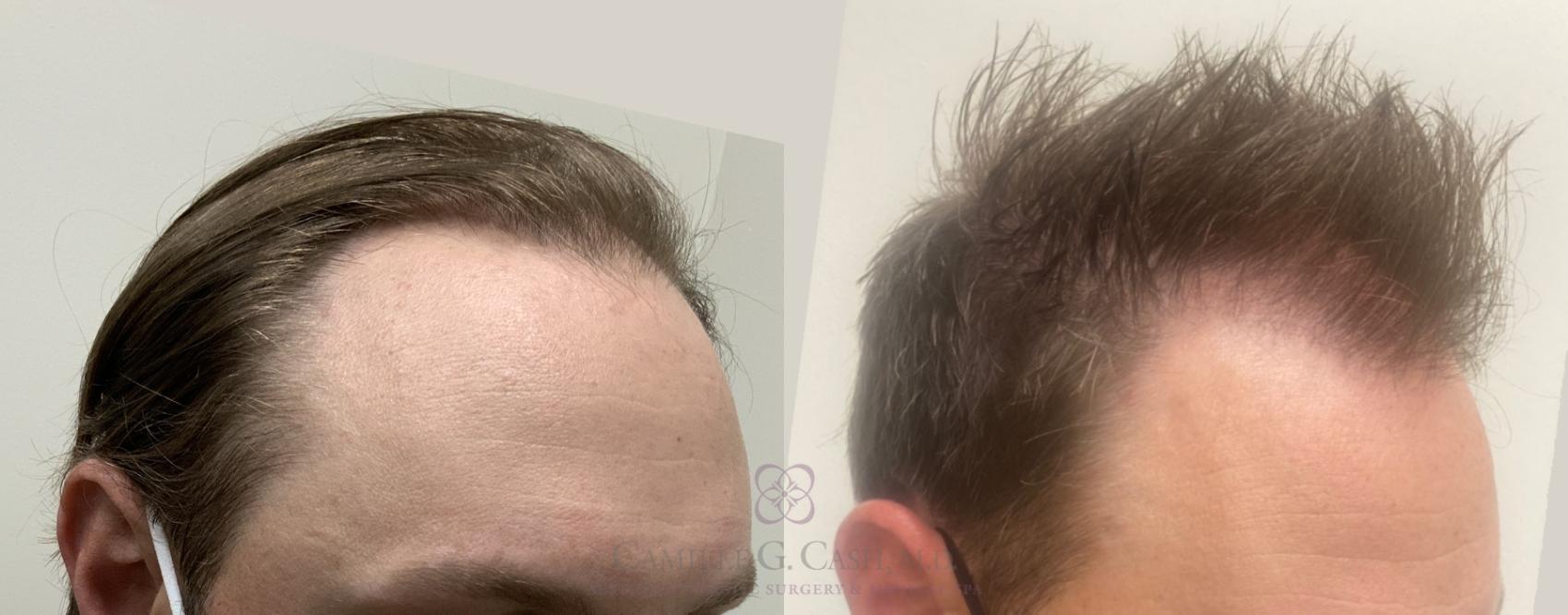 Before & After SmartGraft®  Case 488 oblique1 View in Houston, TX
