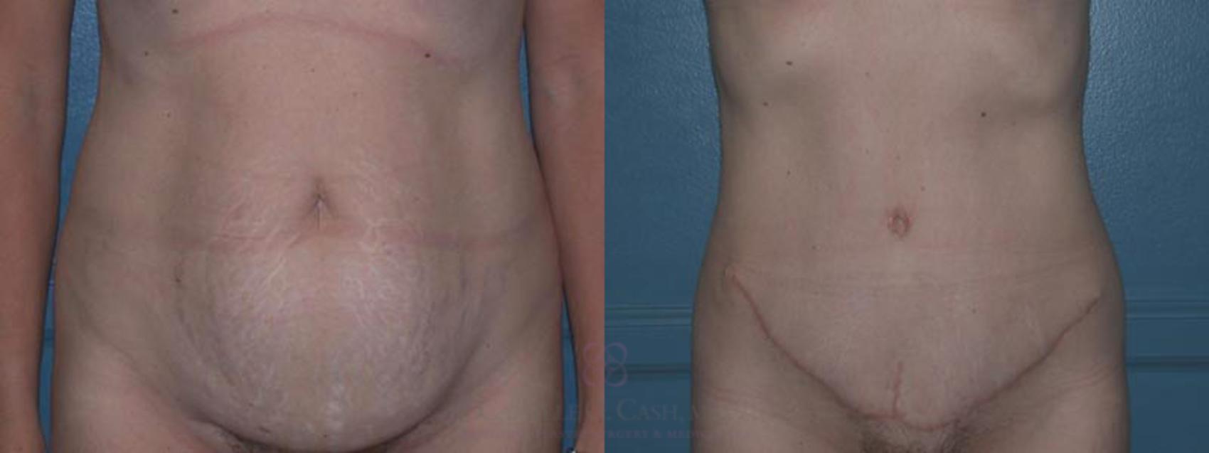 Before & After Tummy Tuck Case 10 View #1 View in Houston, TX