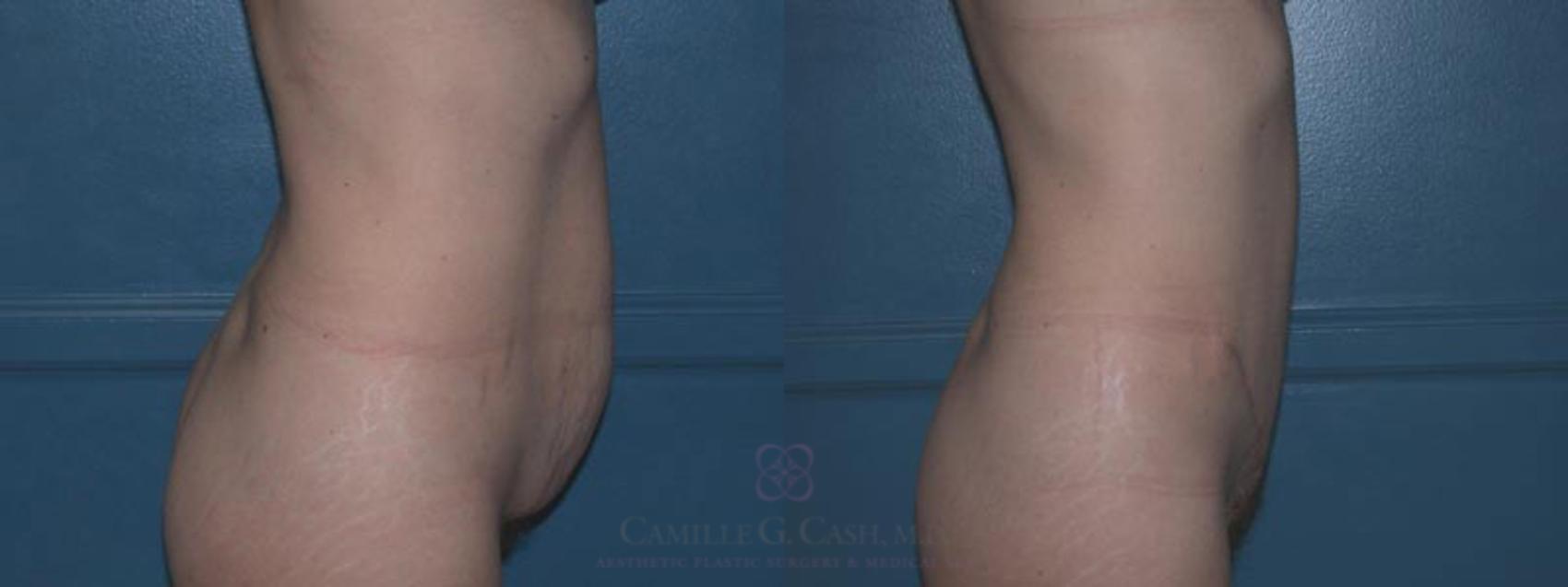 Before & After Tummy Tuck Case 10 View #2 View in Houston, TX