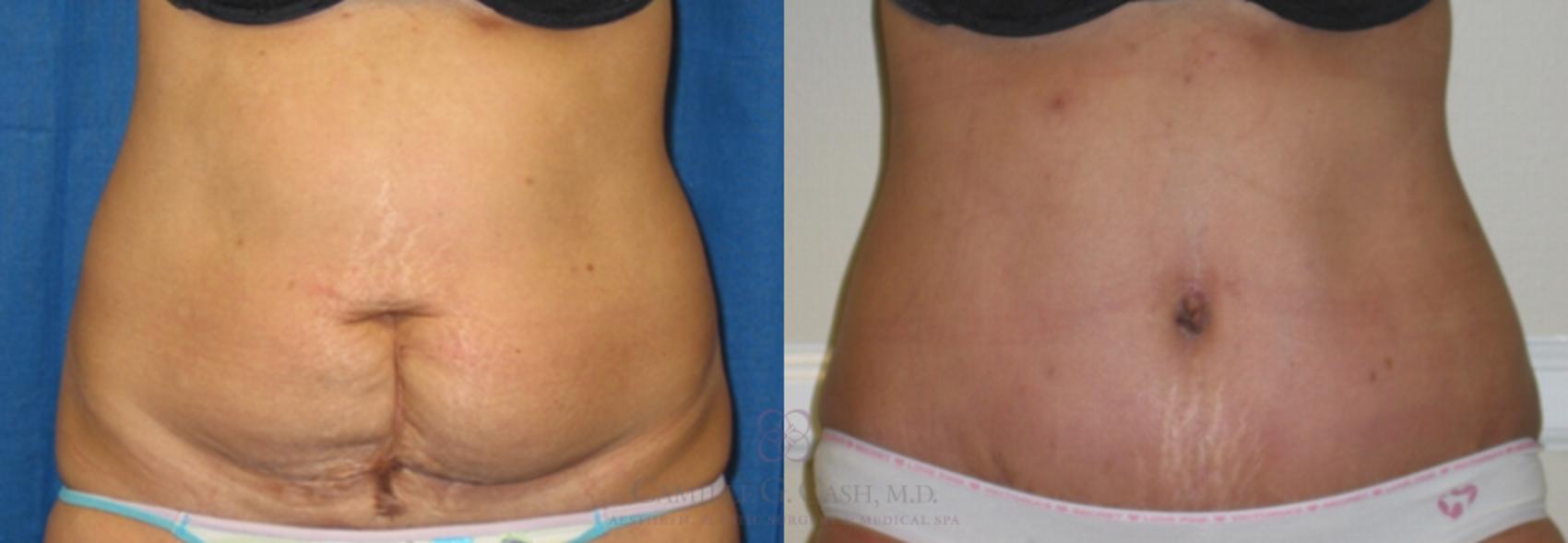 Before & After Tummy Tuck Case 112 View #2 View in Houston, TX
