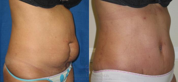 Before & After Tummy Tuck Case 112 View #3 View in Houston, TX