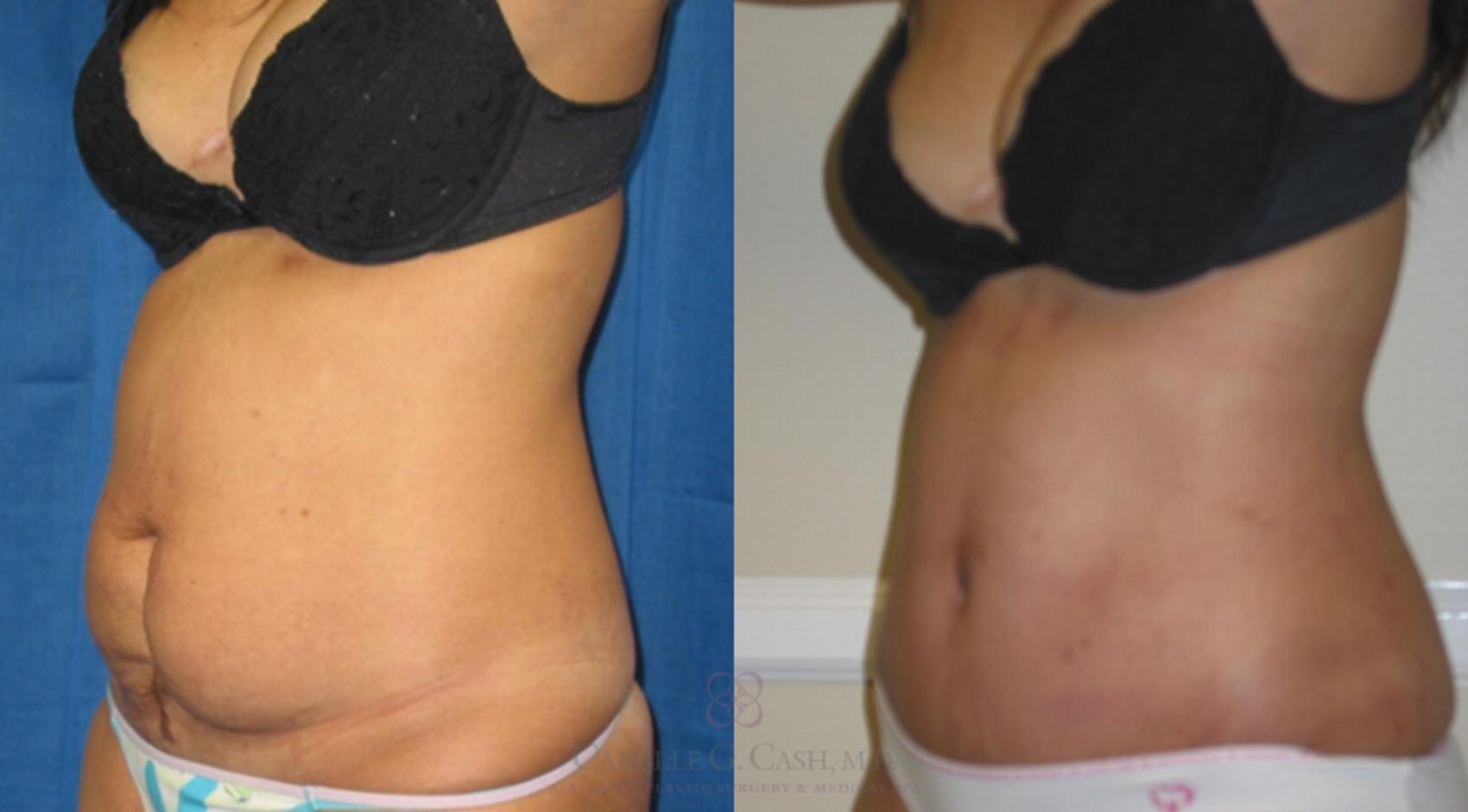 Before & After Tummy Tuck Case 112 View #4 View in Houston, TX