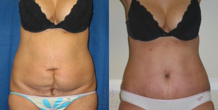 Before & After Tummy Tuck Case 112 View #5 View in Houston, TX