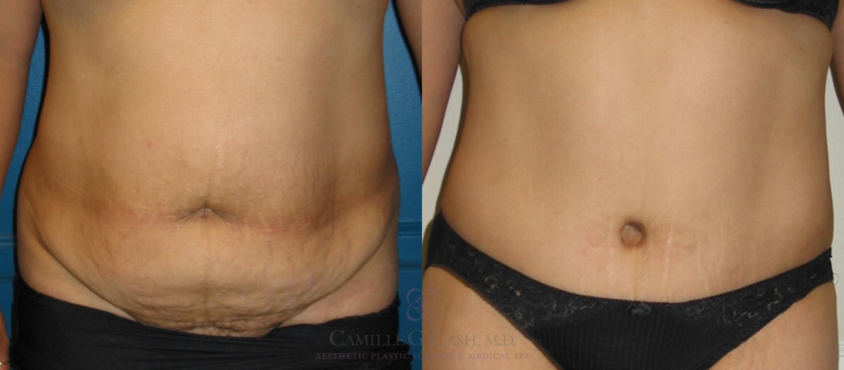 Before & After Tummy Tuck Case 117 View #1 View in Houston, TX