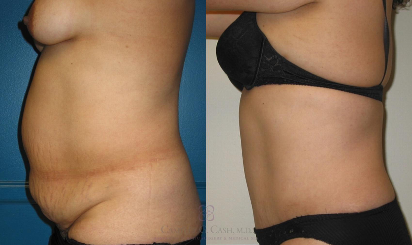 Before & After Tummy Tuck Case 117 View #2 View in Houston, TX
