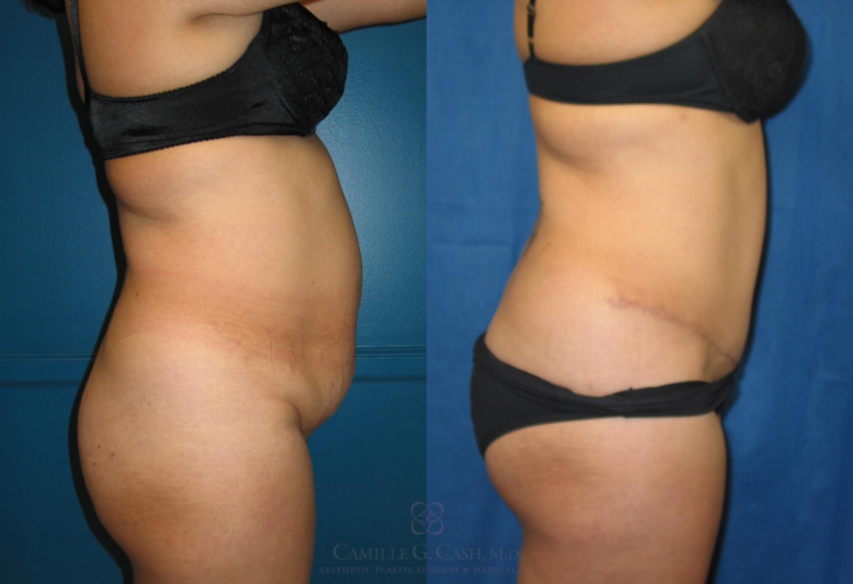 Before & After Tummy Tuck Case 117 View #3 View in Houston, TX