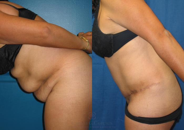 Before & After Tummy Tuck Case 117 View #4 View in Houston, TX