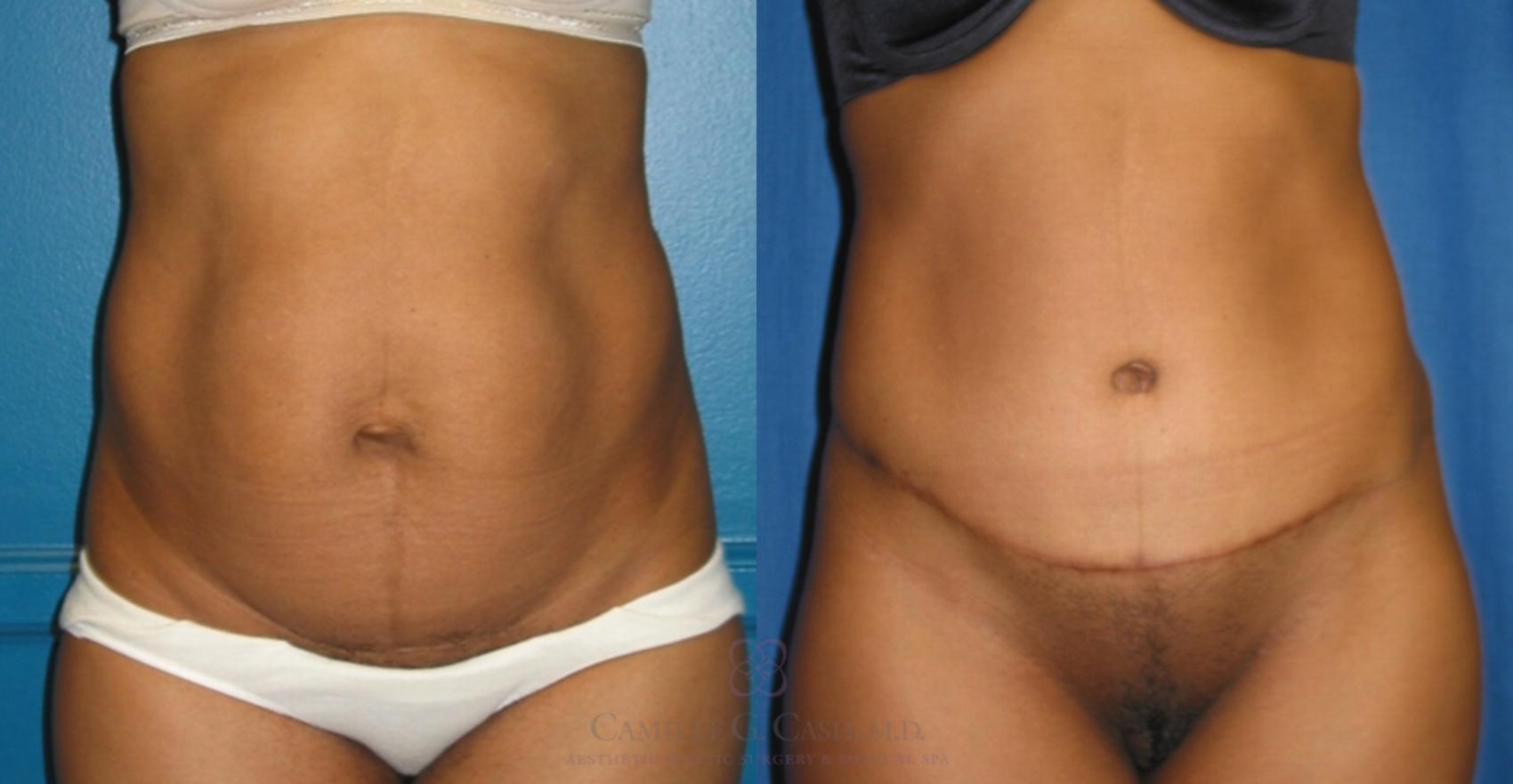 Before & After Tummy Tuck Case 118 View #1 View in Houston, TX