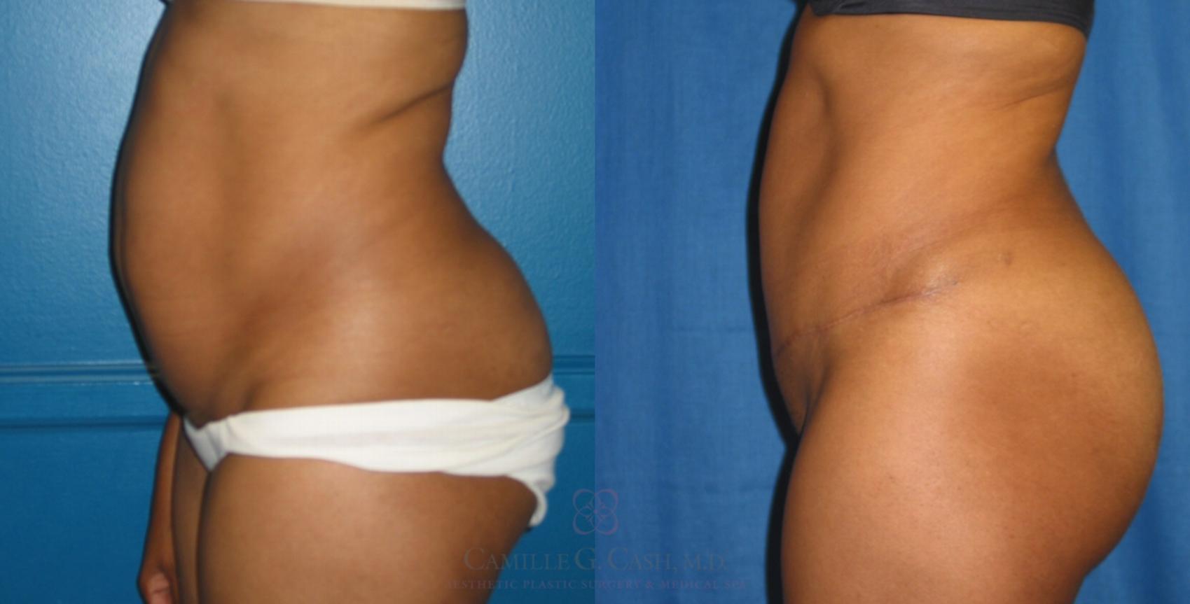 Before & After Tummy Tuck Case 118 View #2 View in Houston, TX