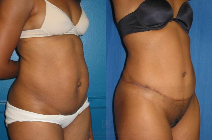 Before & After Tummy Tuck Case 118 View #3 View in Houston, TX