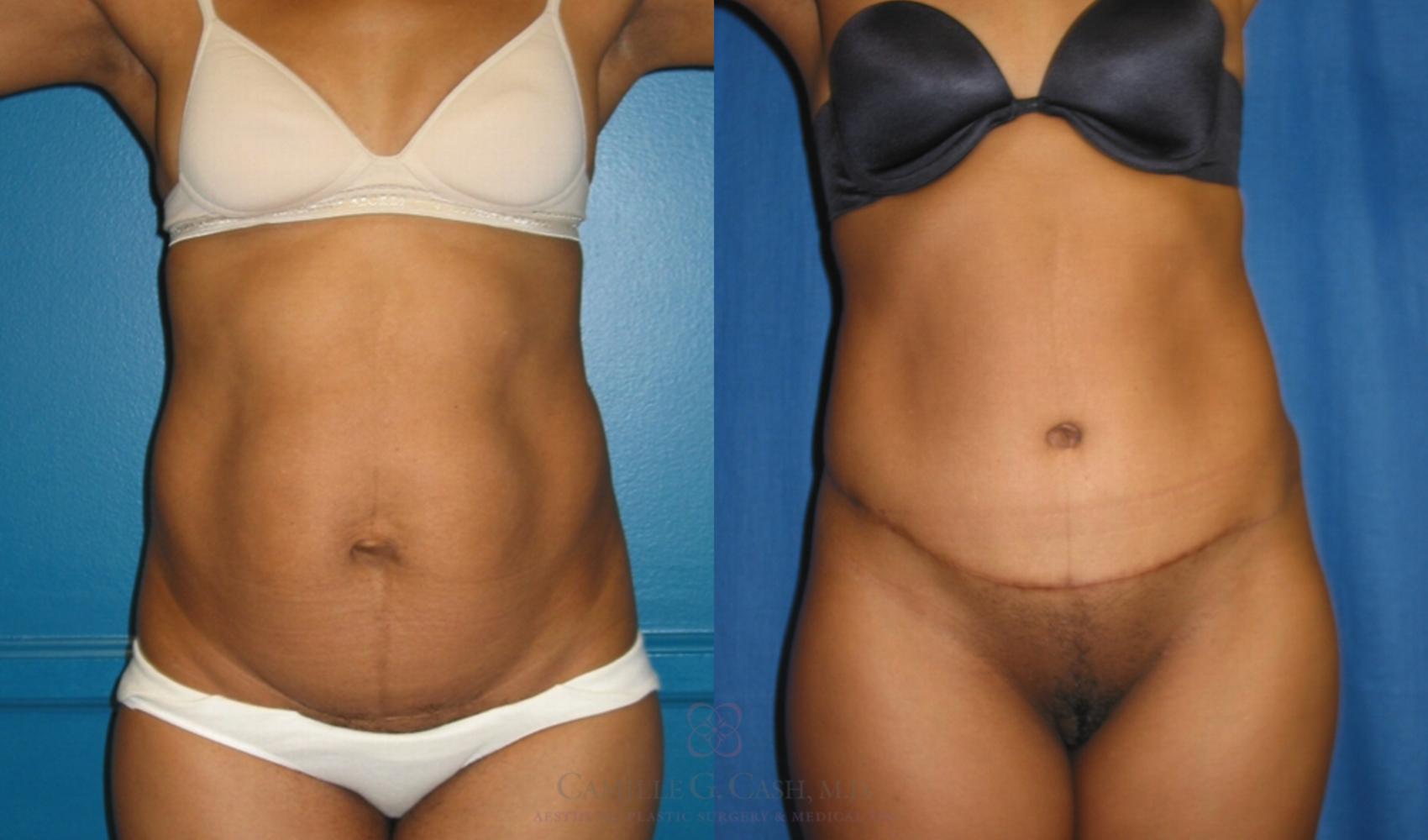 Before & After Tummy Tuck Case 118 View #4 View in Houston, TX