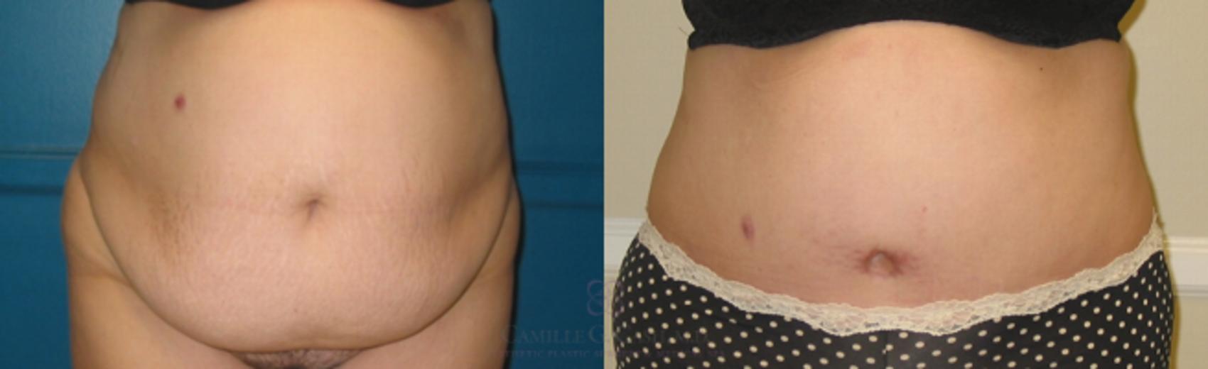 Before & After Tummy Tuck Case 119 View #1 View in Houston, TX