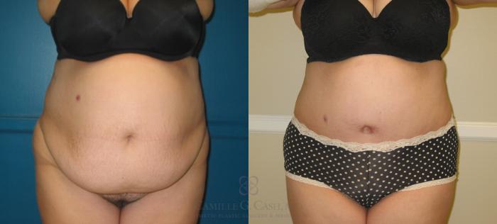 Before & After Tummy Tuck Case 119 View #2 View in Houston, TX