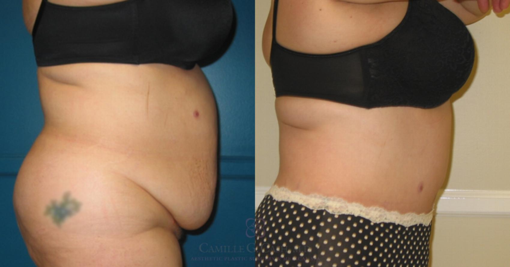 Before & After Tummy Tuck Case 119 View #3 View in Houston, TX
