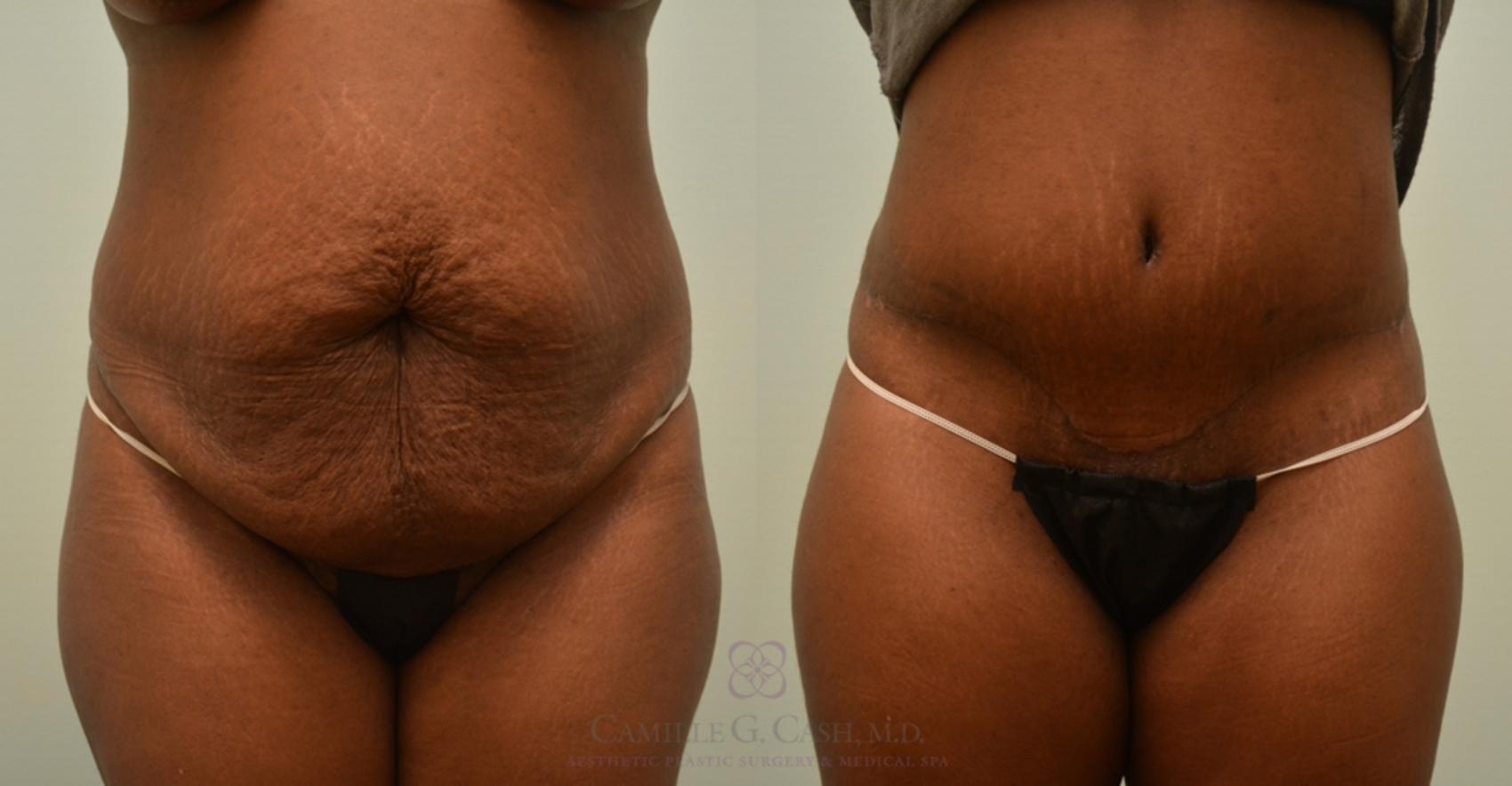Before & After Tummy Tuck Case 121 View #1 View in Houston, TX