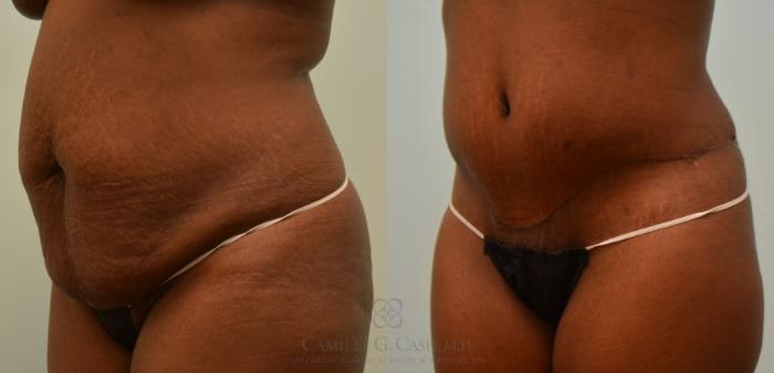 Before & After Tummy Tuck Case 121 View #3 View in Houston, TX