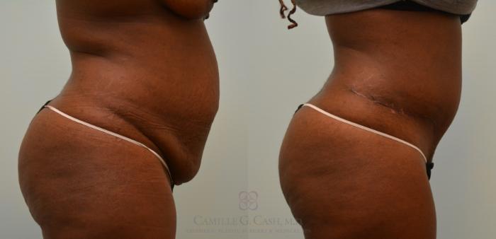 Before & After Tummy Tuck Case 121 View #4 View in Houston, TX