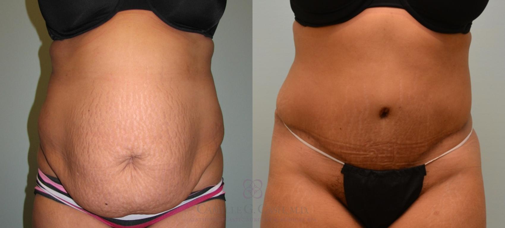 Before & After Tummy Tuck Case 122 View #1 View in Houston, TX