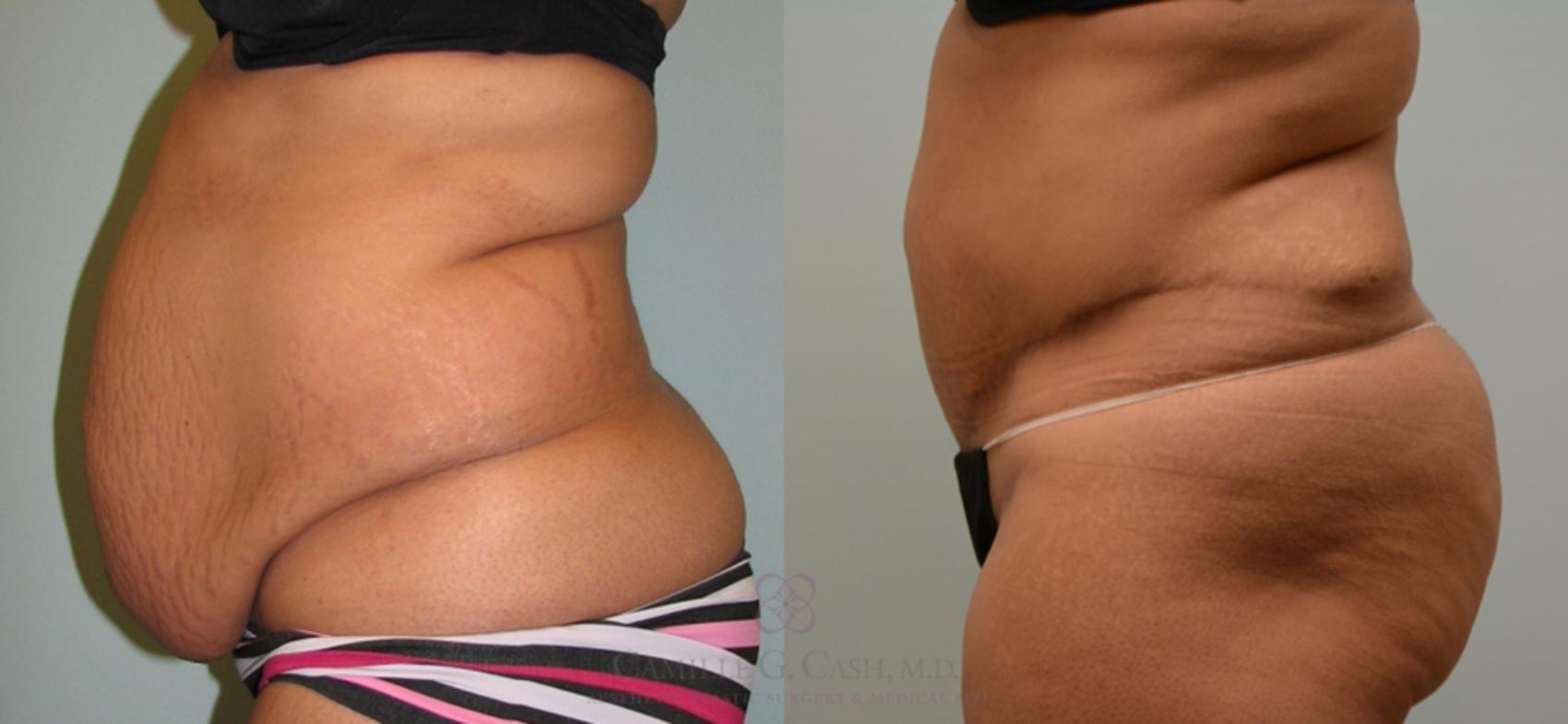Before & After Tummy Tuck Case 122 View #2 View in Houston, TX