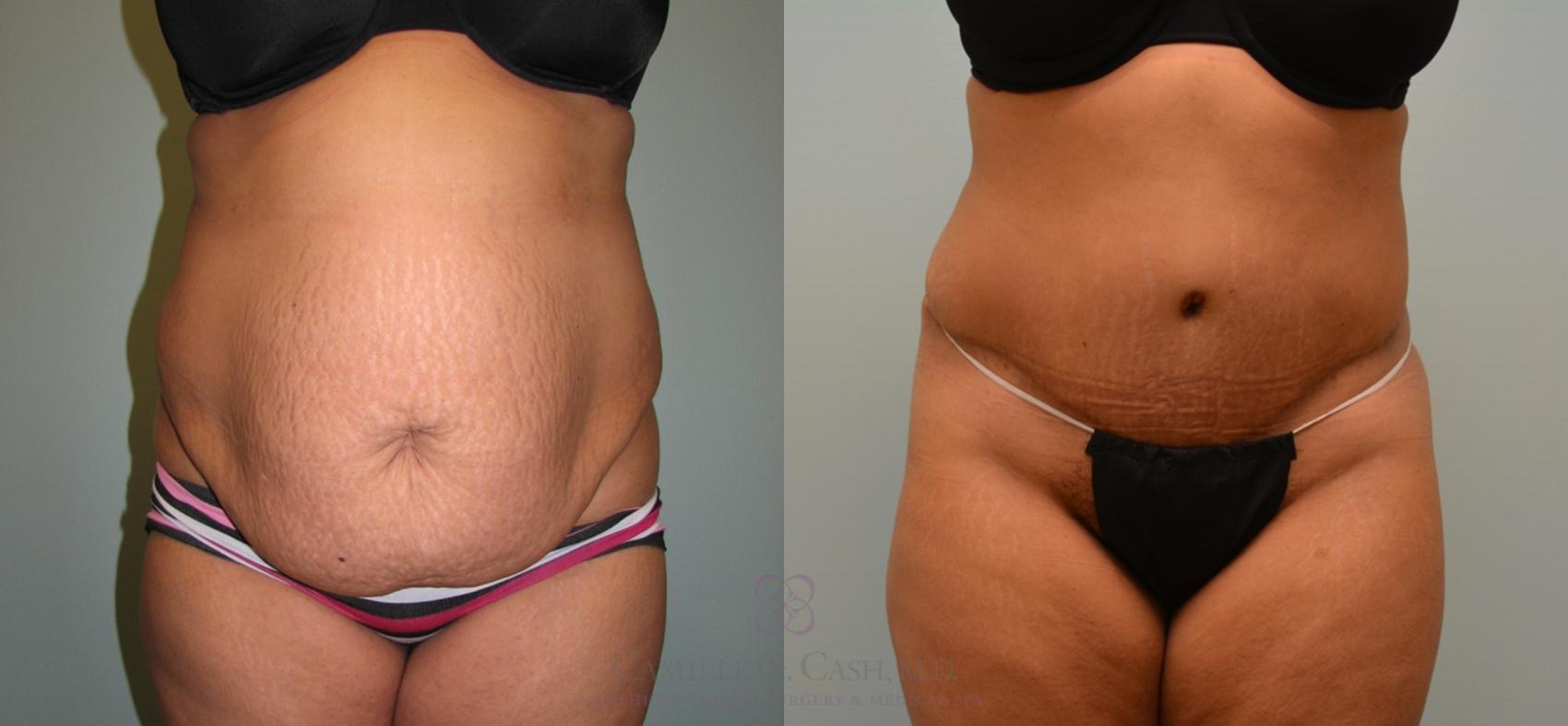 Before & After Tummy Tuck Case 122 View #3 View in Houston, TX